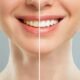 "Before and after teeth whitening showing stained teeth on the left and bright white teeth on the right"