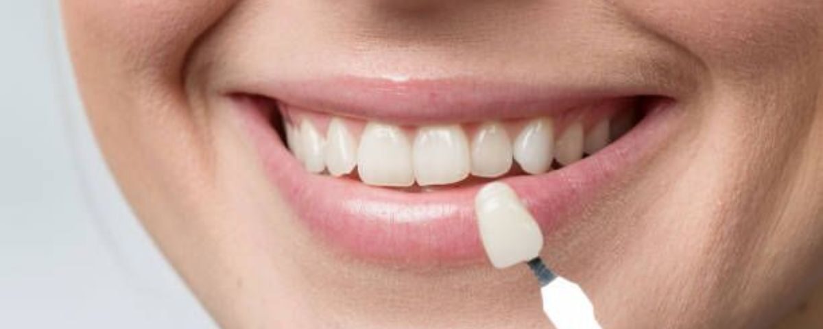 ceramic veneers