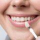 ceramic veneers