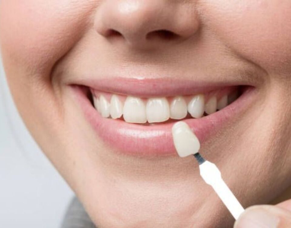 ceramic veneers
