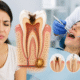 root canal treatment