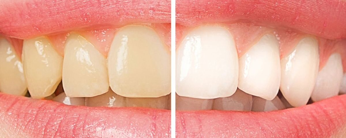 best foods for healthy teeth and gums