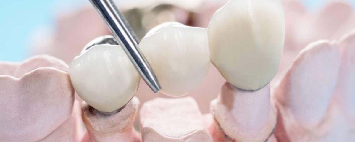 dental crowns vs bridges