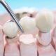 dental crowns vs bridges