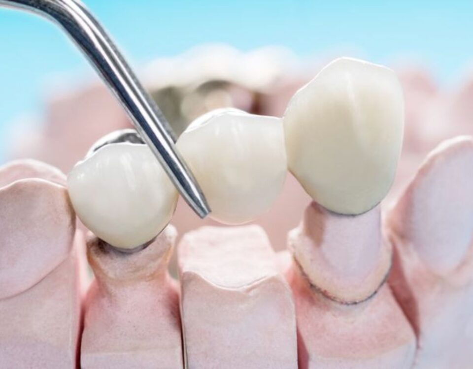 dental crowns vs bridges