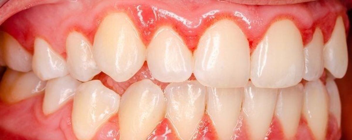 bleeding gums