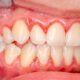 bleeding gums