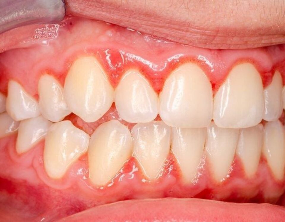 bleeding gums