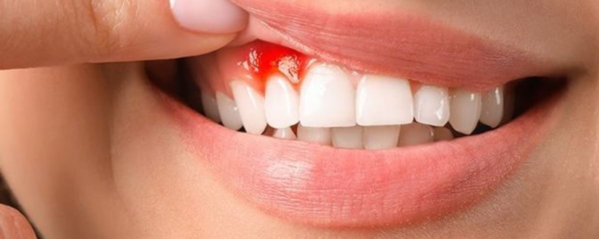 bleeding gums