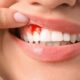 bleeding gums