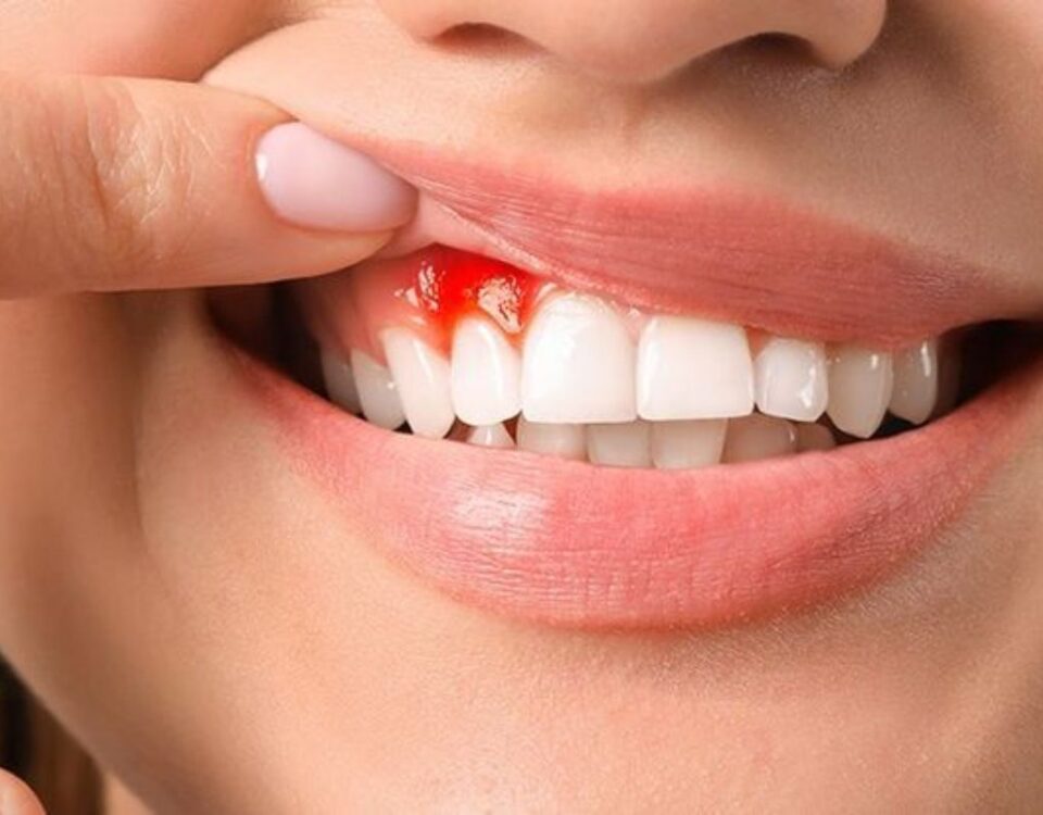 bleeding gums