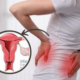 uterine fibroids